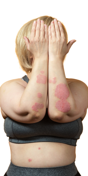 Person covering their face with both hands, showing plaque psoriasis patches on the forearms and elbows against a white background.